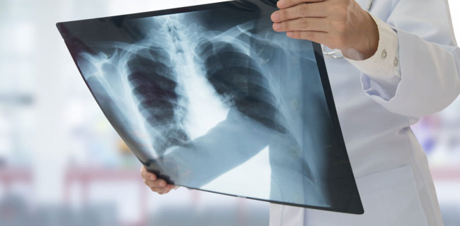 Pneumothorax et assurance de prêt : comment vous assurer sereinement